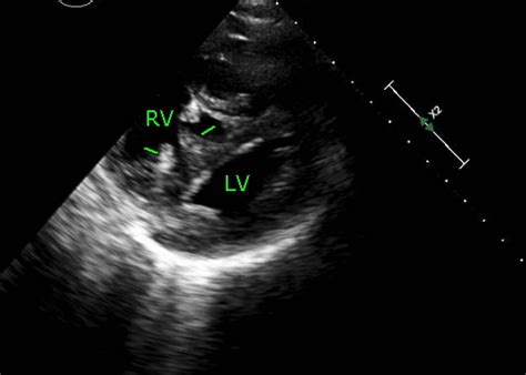 lv d shape|d shaped left ventricular dysfunction.